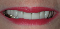 Veneers