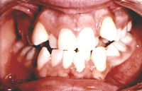 before teeth