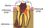 Decayed Tooth