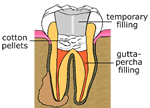 Temporary Filling